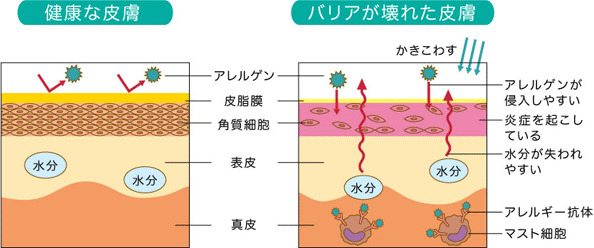 バリア機能の崩壊
